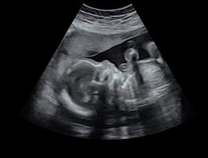 baby in ultrasound machine