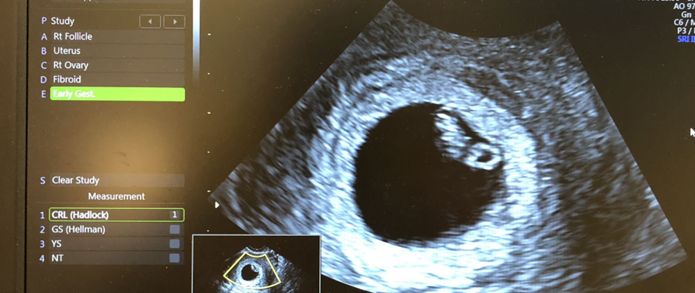 Julie's Journey - First Ultrasound - Abundant Beginnings Company